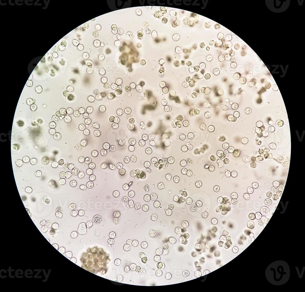 Pyuria or leukocyturia is the condition of urine containing white blood cells or pus. It can be a sign of a bacterial urinary tract infection photo