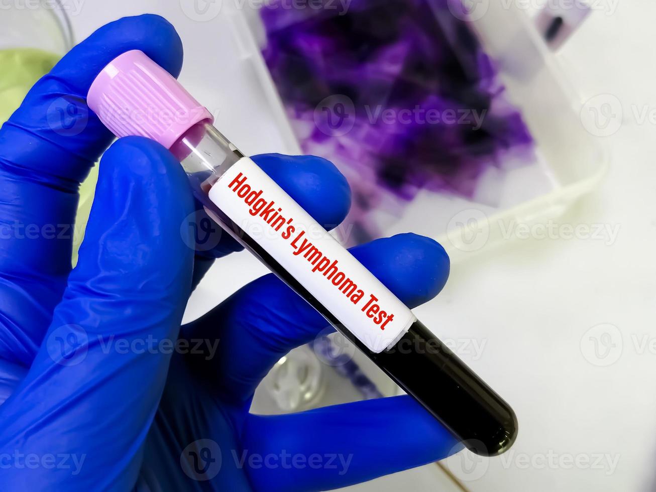Blood sample for Hodgkin's lymphoma test, a type of cancer that affects the lymphatic system. photo