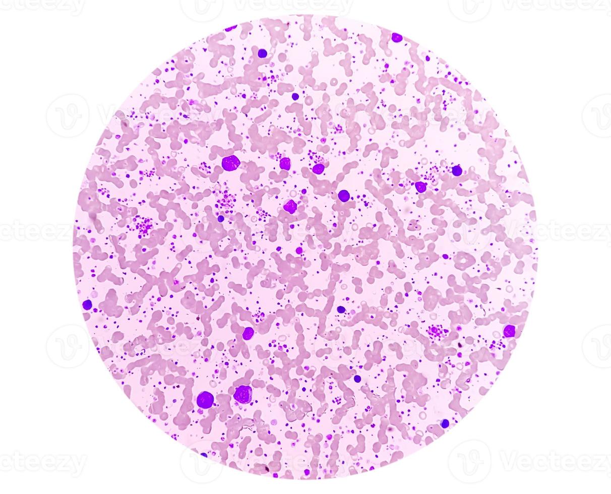 Chronic myeloid leukemia in accelerated phase with thrombocytosis. Chronic myelogenous leukemia. photo