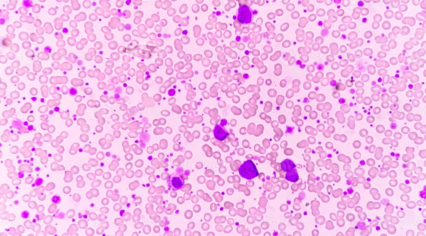 Chronic myeloid leukemia or CML in accelerated phase with thrombocytosis. Chronic myelogenous leukemia. photo