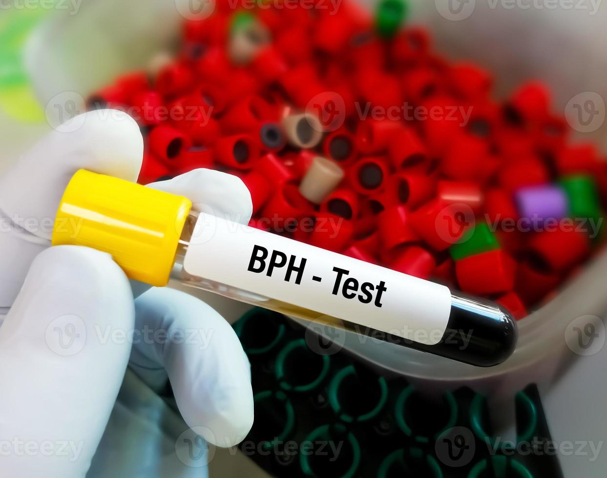 Blood sample Benign prostate hyperplasia or BPH, prostate health testing. photo