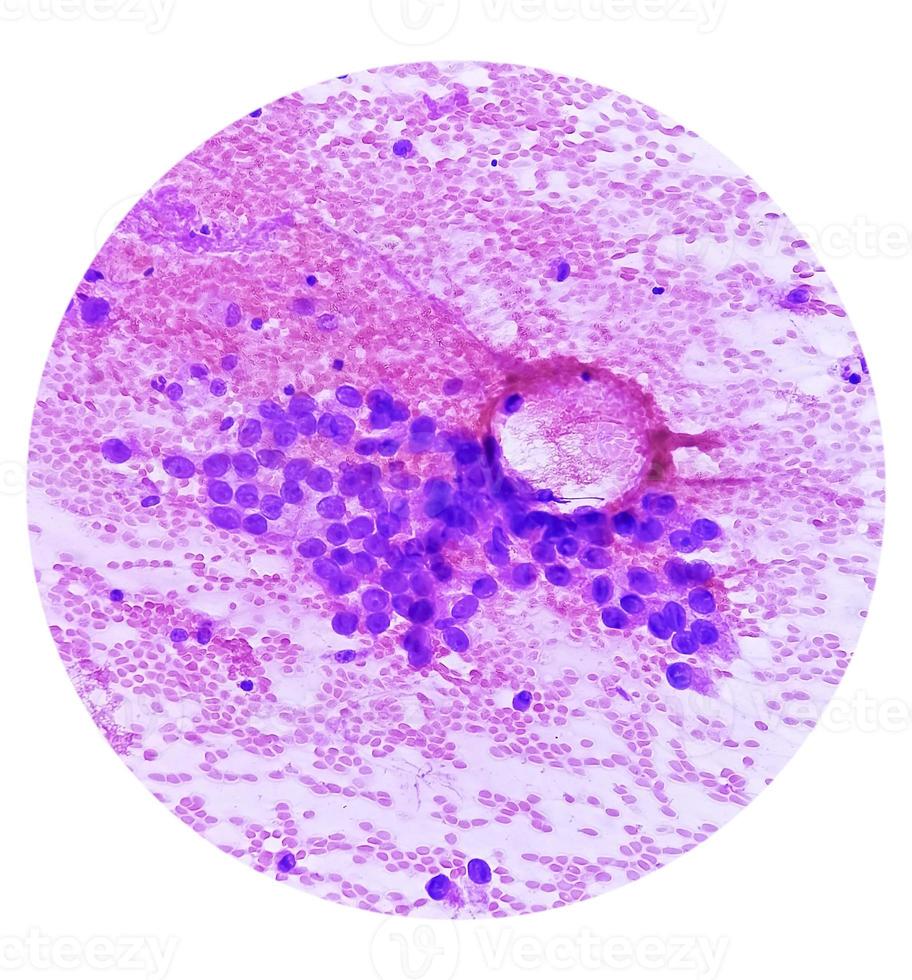 Photomicrograph of fine needle aspiration cytology of a pulmonary nodule showing adenocarcinoma, a type of non small cell carcinoma. photo