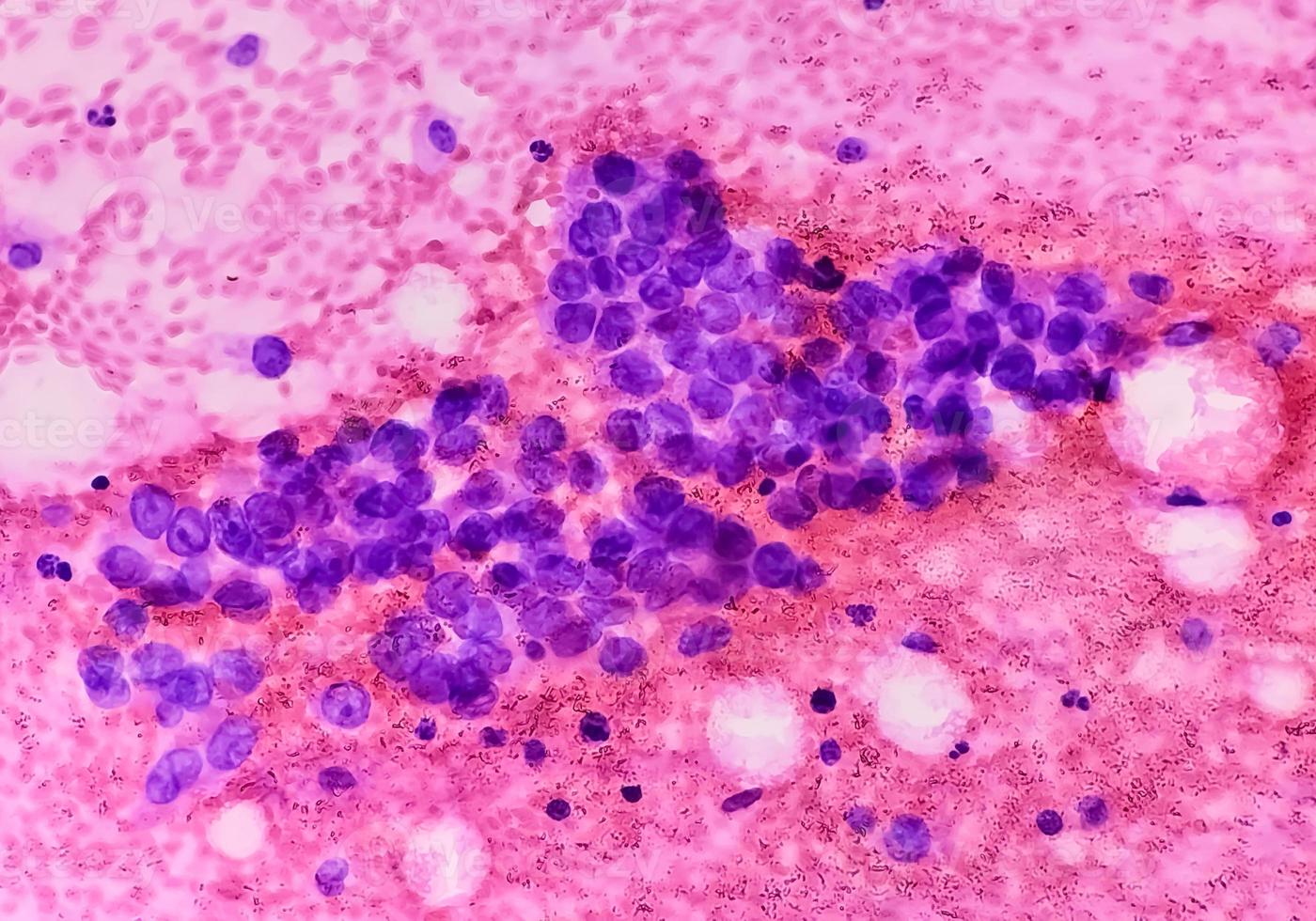 Photomicrograph of fine needle aspiration cytology of a pulmonary nodule showing adenocarcinoma, a type of non small cell carcinoma. photo