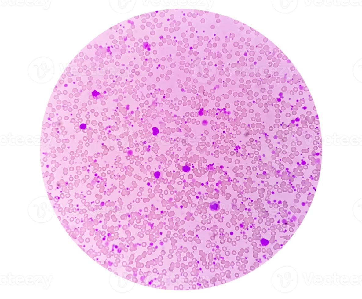 Chronic myeloid leukemia or CML in accelerated phase with thrombocytosis. Chronic myelogenous leukemia. photo