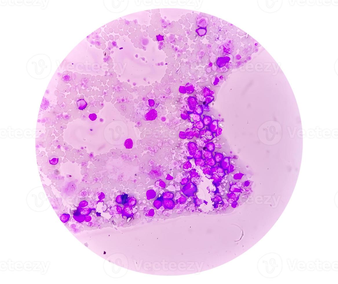 Chronic myeloid leukemia or CML in accelerated phase with thrombocytosis. Chronic myelogenous leukemia. photo