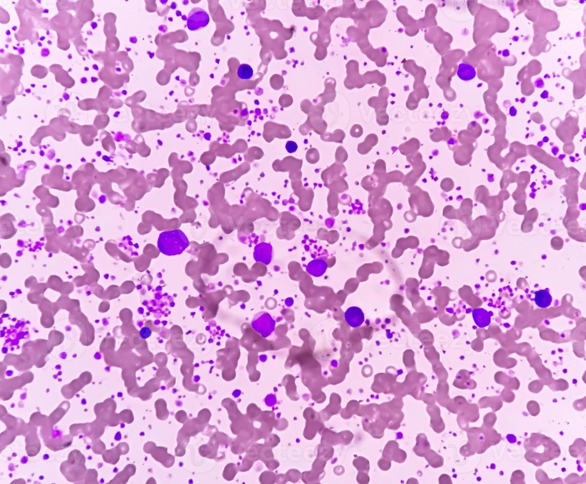 Chronic myeloid leukemia or CML in accelerated phase with thrombocytosis. Chronic myelogenous leukemia. photo