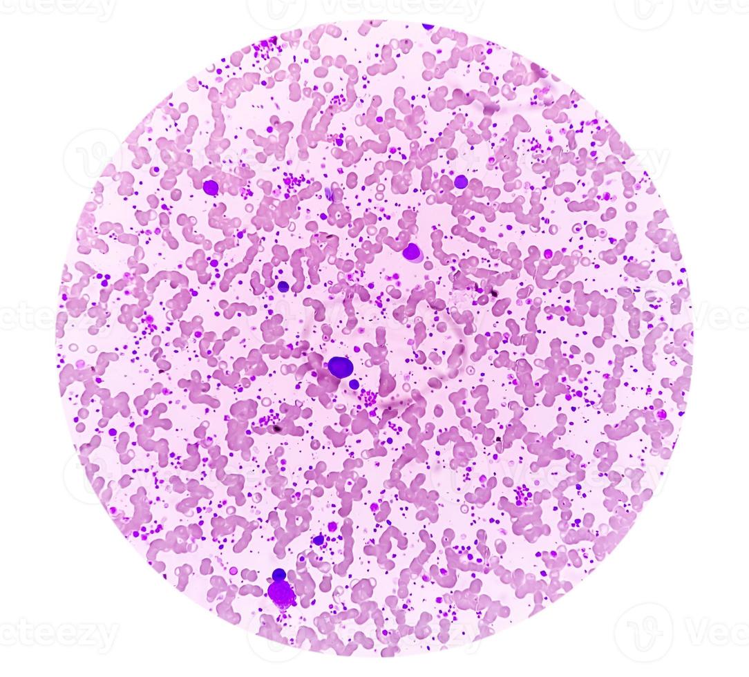 Chronic myeloid leukemia or CML in accelerated phase with thrombocytosis. Chronic myelogenous leukemia. photo