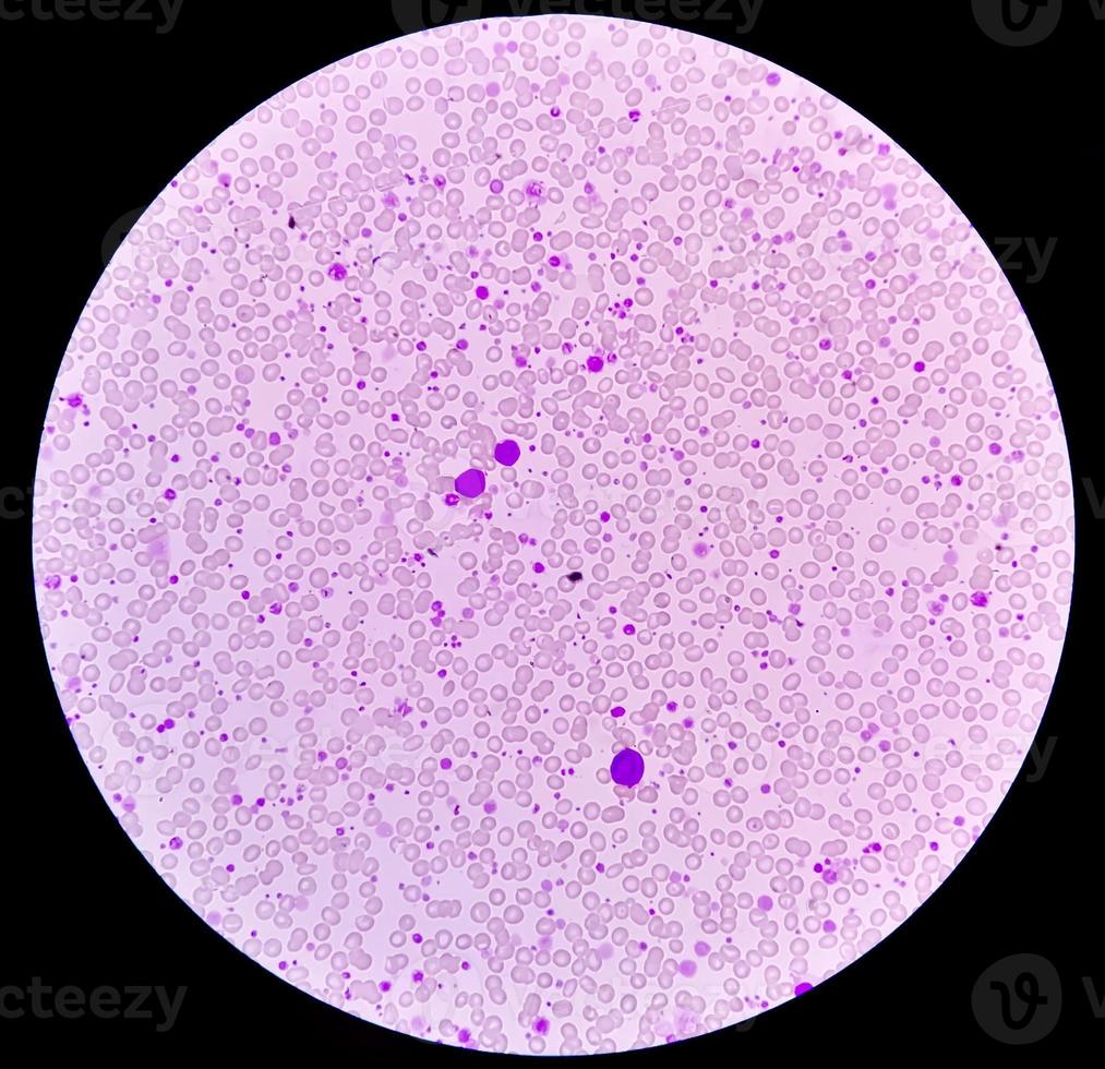 Chronic myeloid leukemia or CML in accelerated phase with thrombocytosis. Chronic myelogenous leukemia. photo