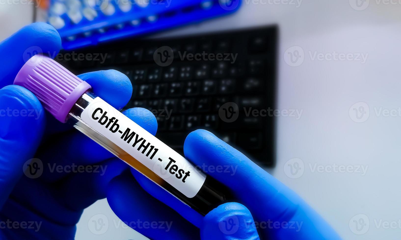 Blood sample for CBFB-MYH11 inv 16 test, inv 16 is one of the most frequent chromosomal translocations associated with acute myeloid leukemia or AML photo