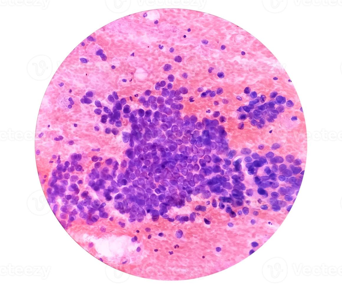 Photomicrograph of fine needle aspiration cytology of a pulmonary nodule showing adenocarcinoma, a type of non small cell carcinoma. photo