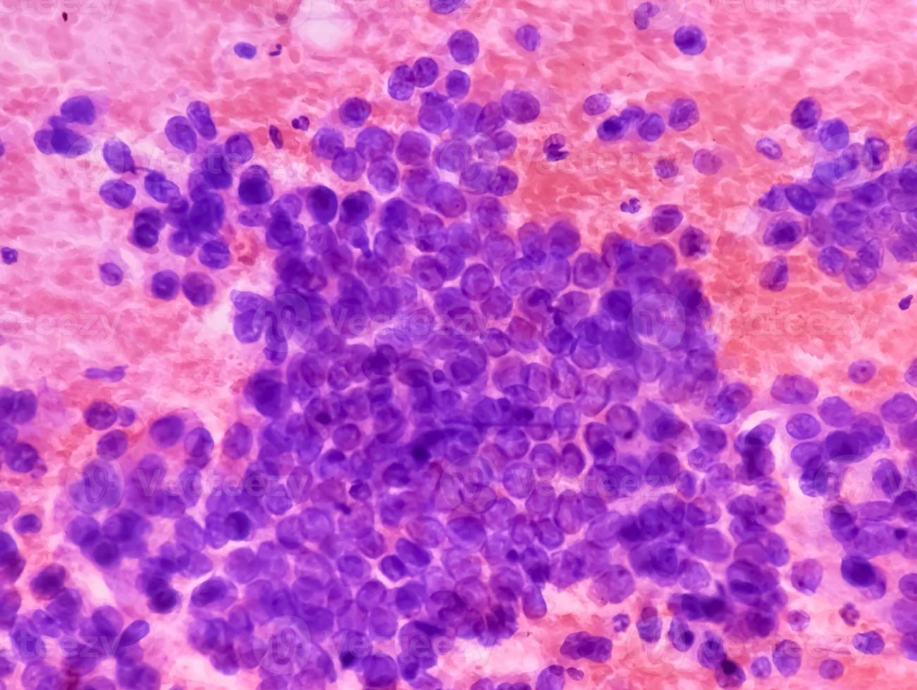 Photomicrograph of fine needle aspiration cytology of a pulmonary nodule showing adenocarcinoma, a type of non small cell carcinoma. photo