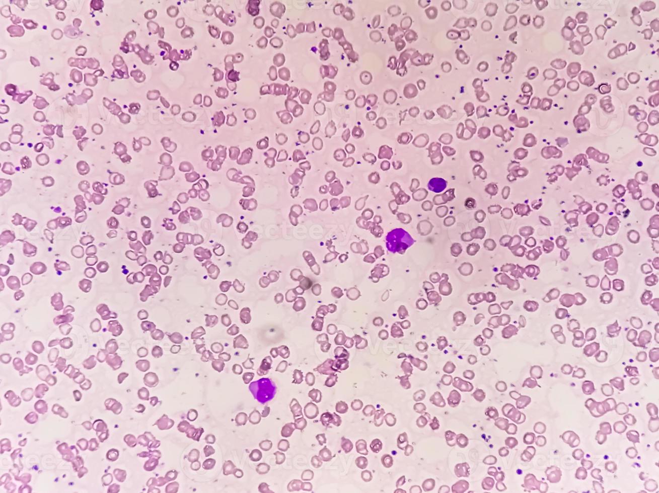Blood Film under microscopic showing Microcytic Hypochromic Anemia photo