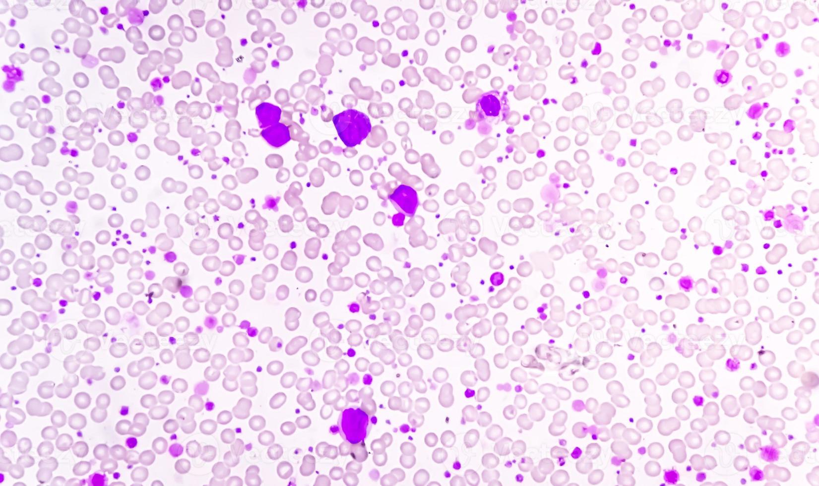 Chronic myeloid leukemia or CML in accelerated phase with thrombocytosis. Chronic myelogenous leukemia. photo