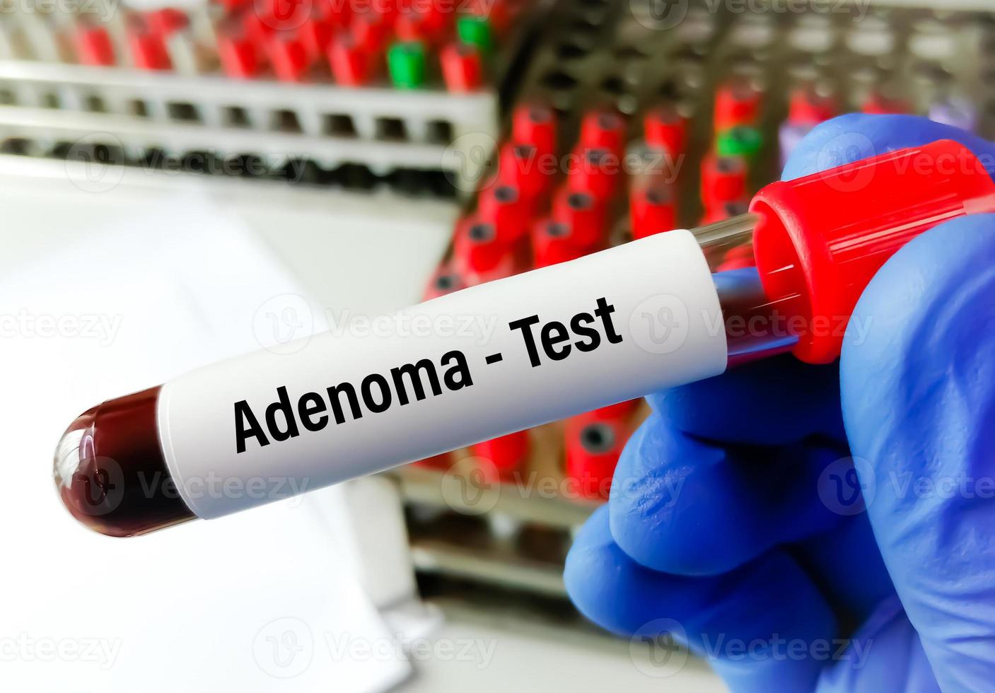 Adenoma blood test, polyps have the potential to become cancerous. photo