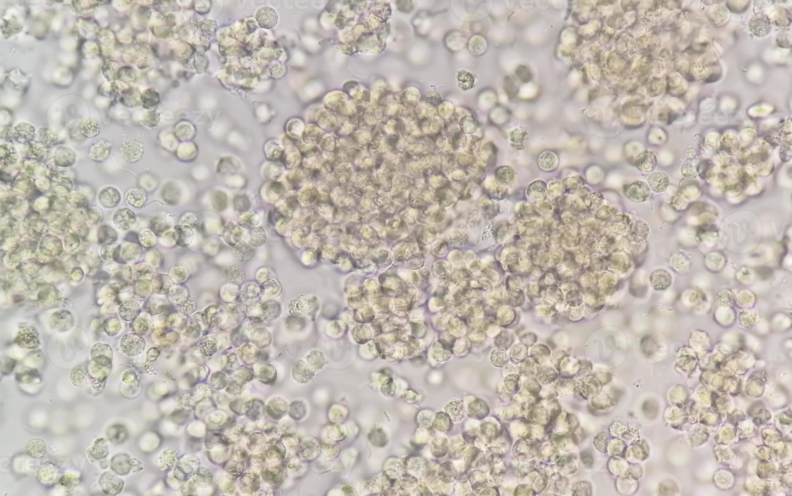 Pyuria or leukocyturia is the condition of urine containing white blood cells or pus. It can be a sign of a bacterial urinary tract infection photo