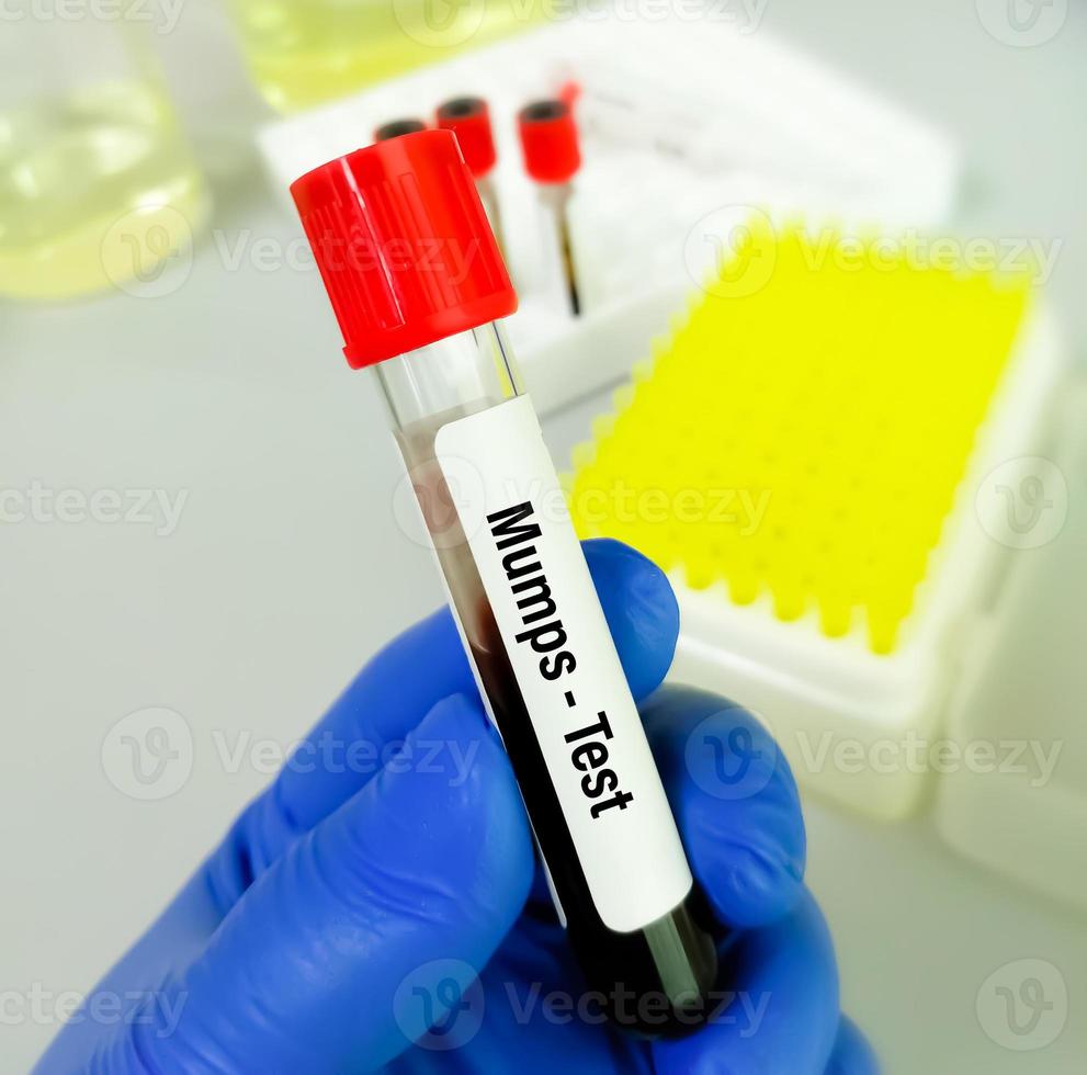 Mumps Test tube with blood sample in infection lab photo