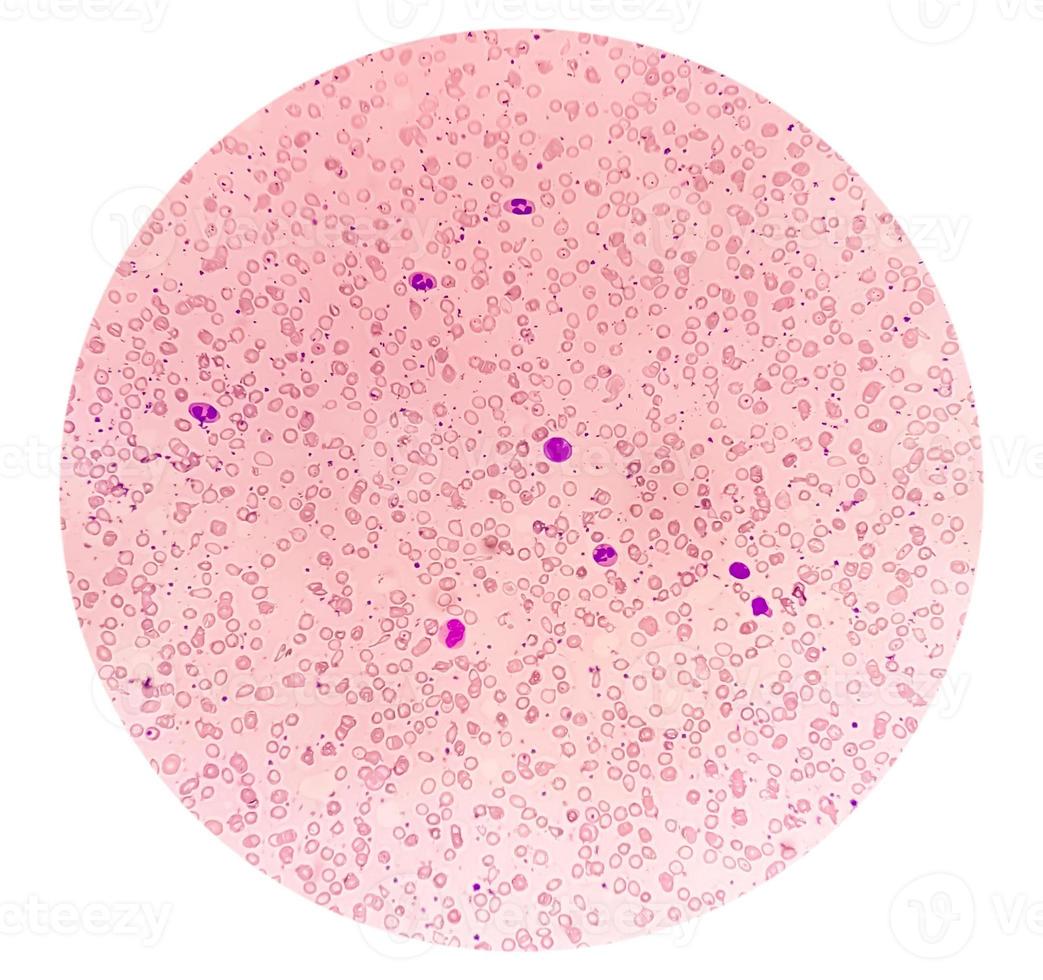 Blood Film under microscopic showing Microcytic Hypochromic Anemia photo