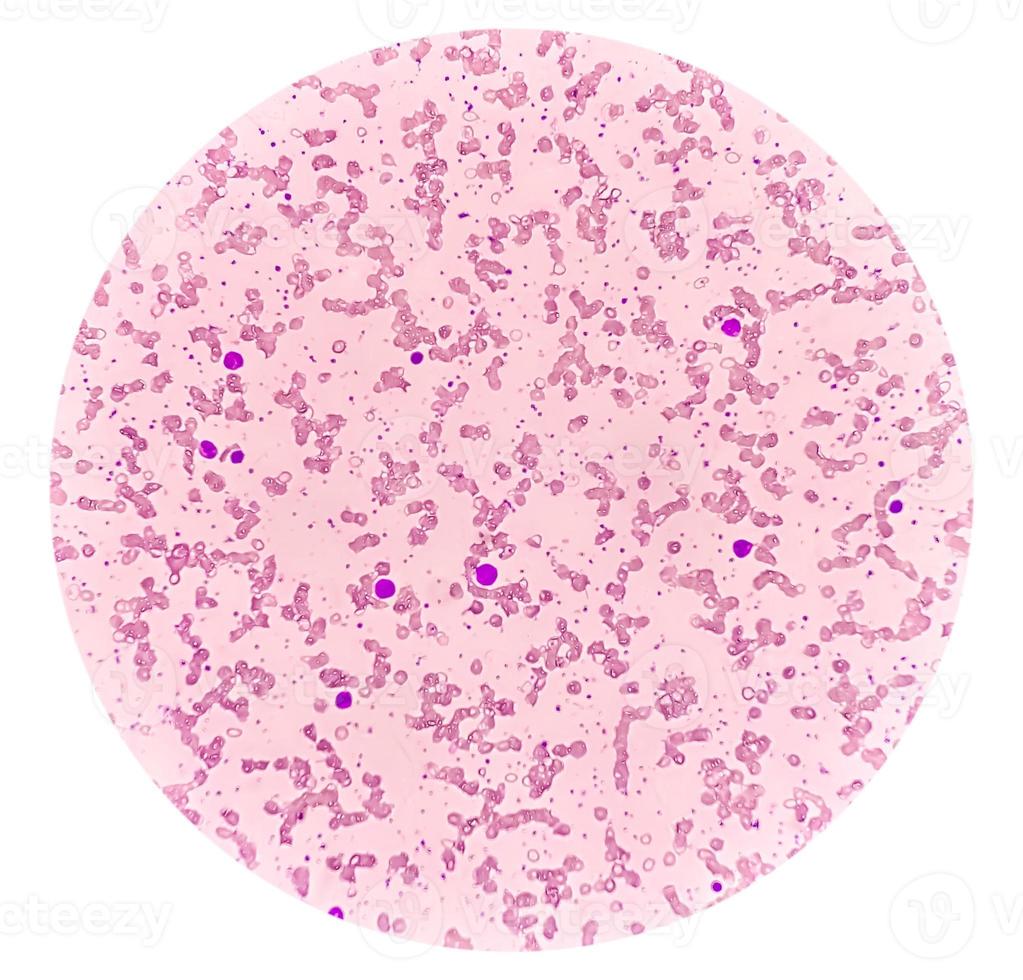 Blood Film under microscopic showing Microcytic Hypochromic Anemia photo