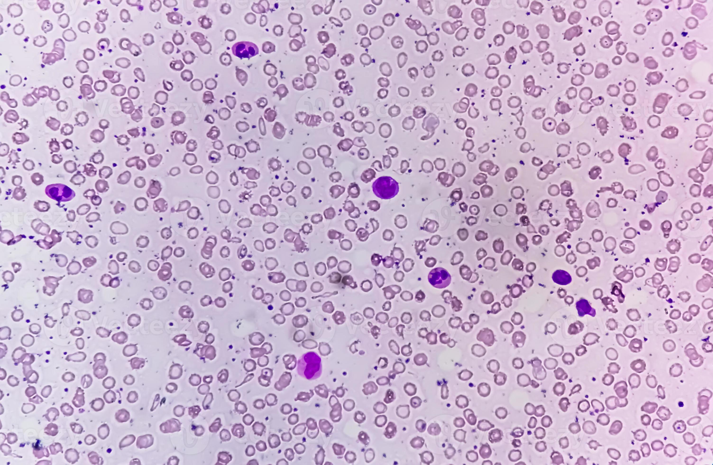 Blood Film under microscopic showing Microcytic Hypochromic Anemia