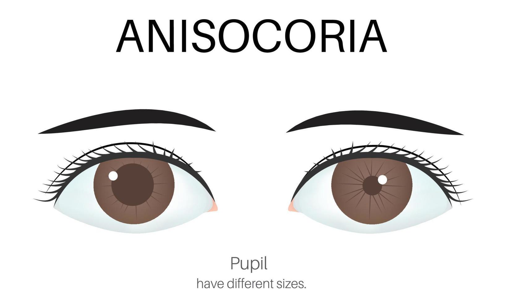 Image of eye with anisocoria. vector