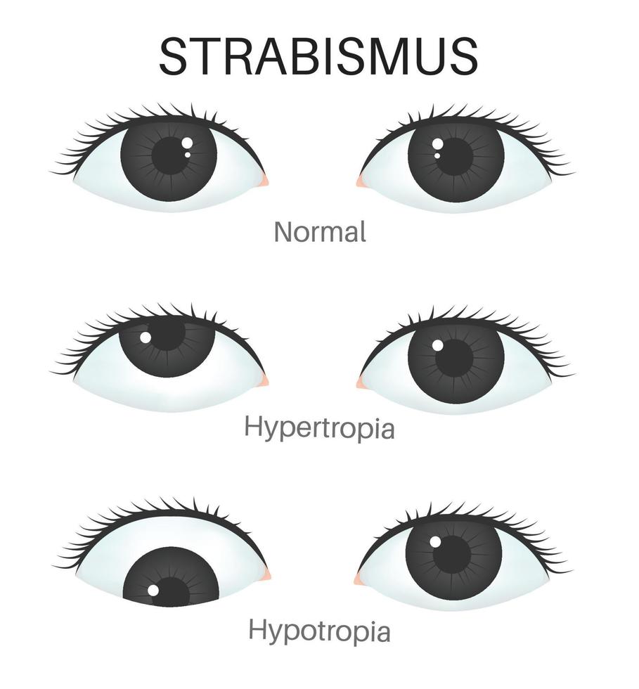 tipos de estrabismo - hipertopía y hipotopia vector