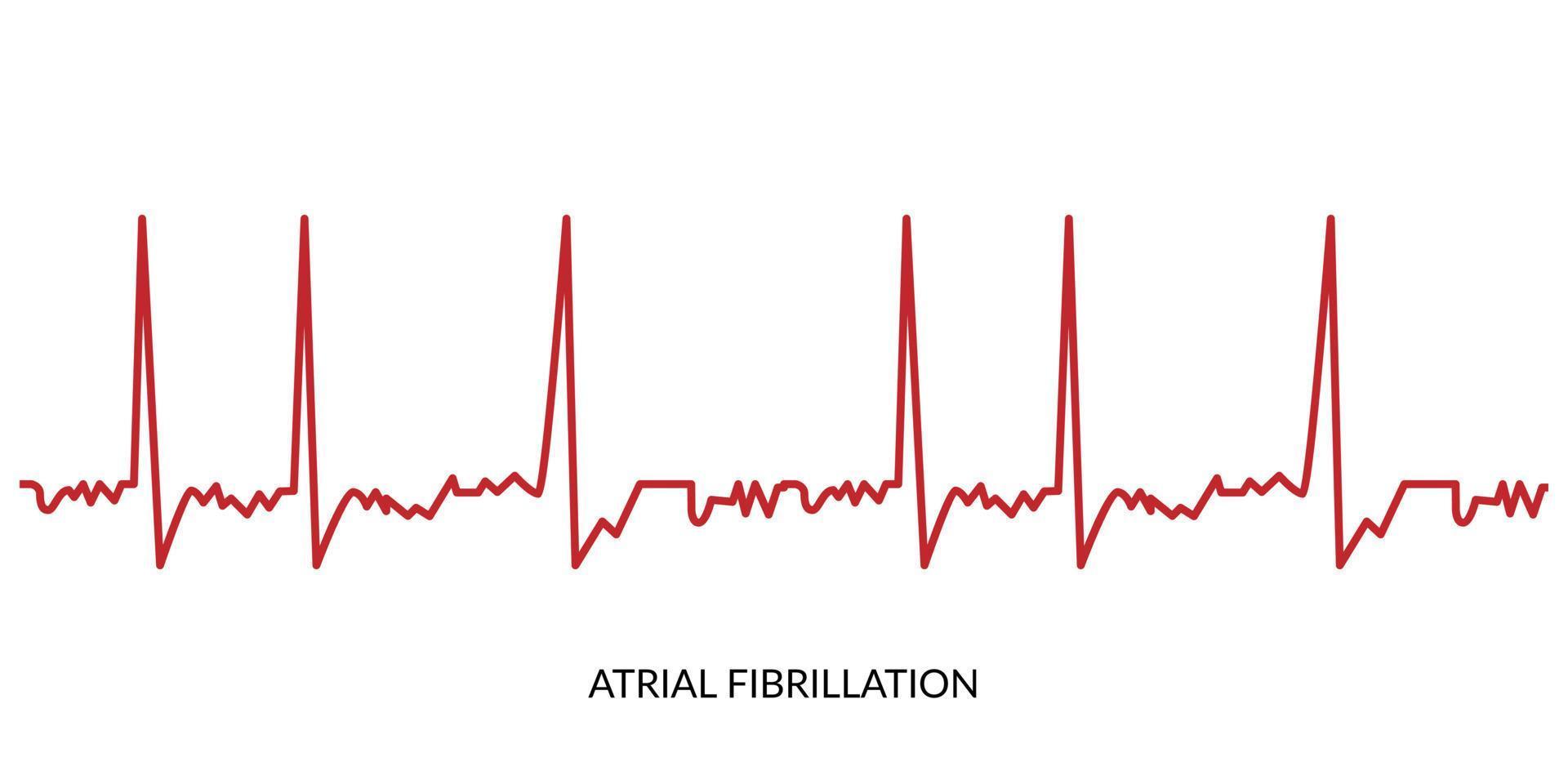 ECG Heartbeat Line. Electrocardiogram vector illustration. Atrial Fibrillation