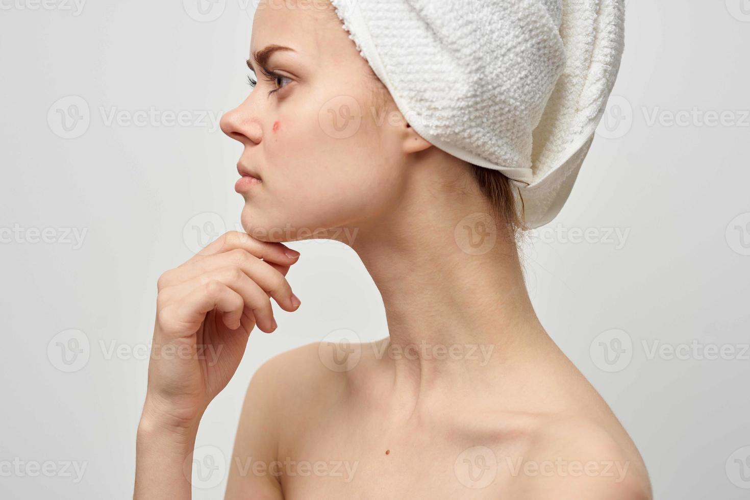 woman with a pimple on the face skin problems close-up photo