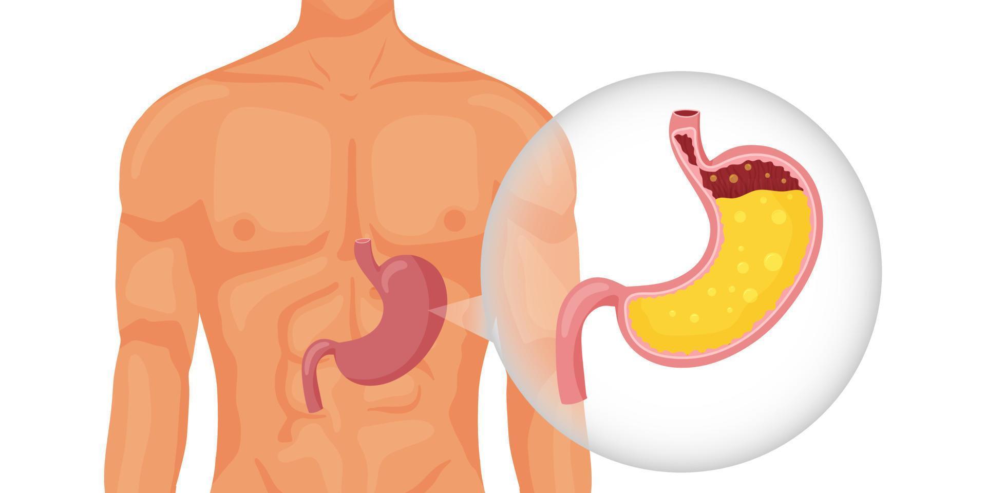 humano estómago lleno de gástrico jugo en cuerpo vector