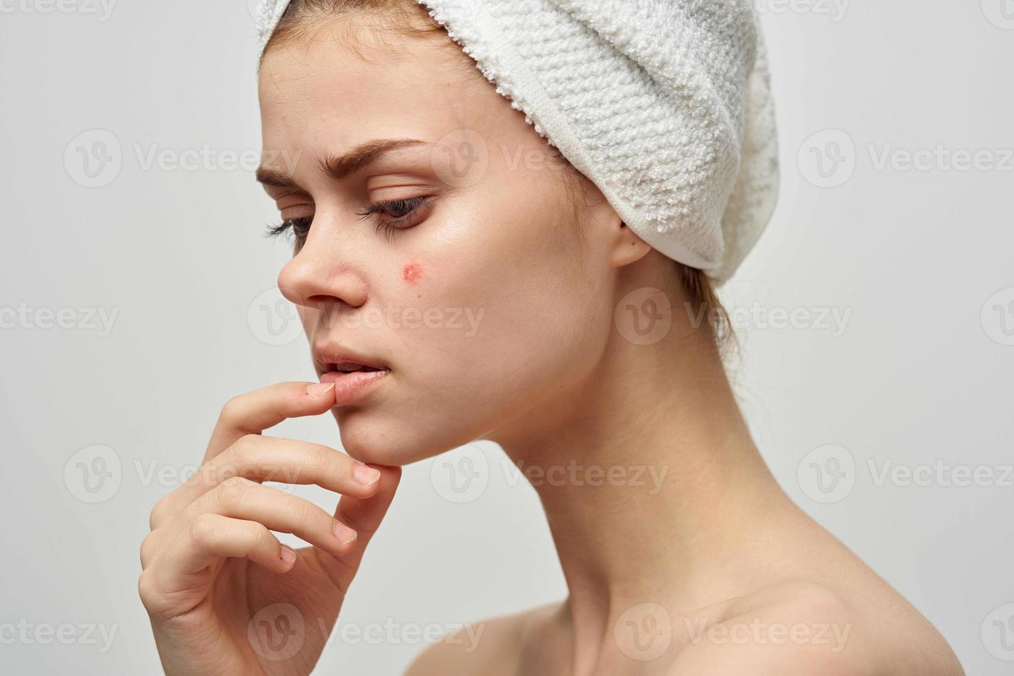 pretty woman with a pimple on the face skin problems close-up photo