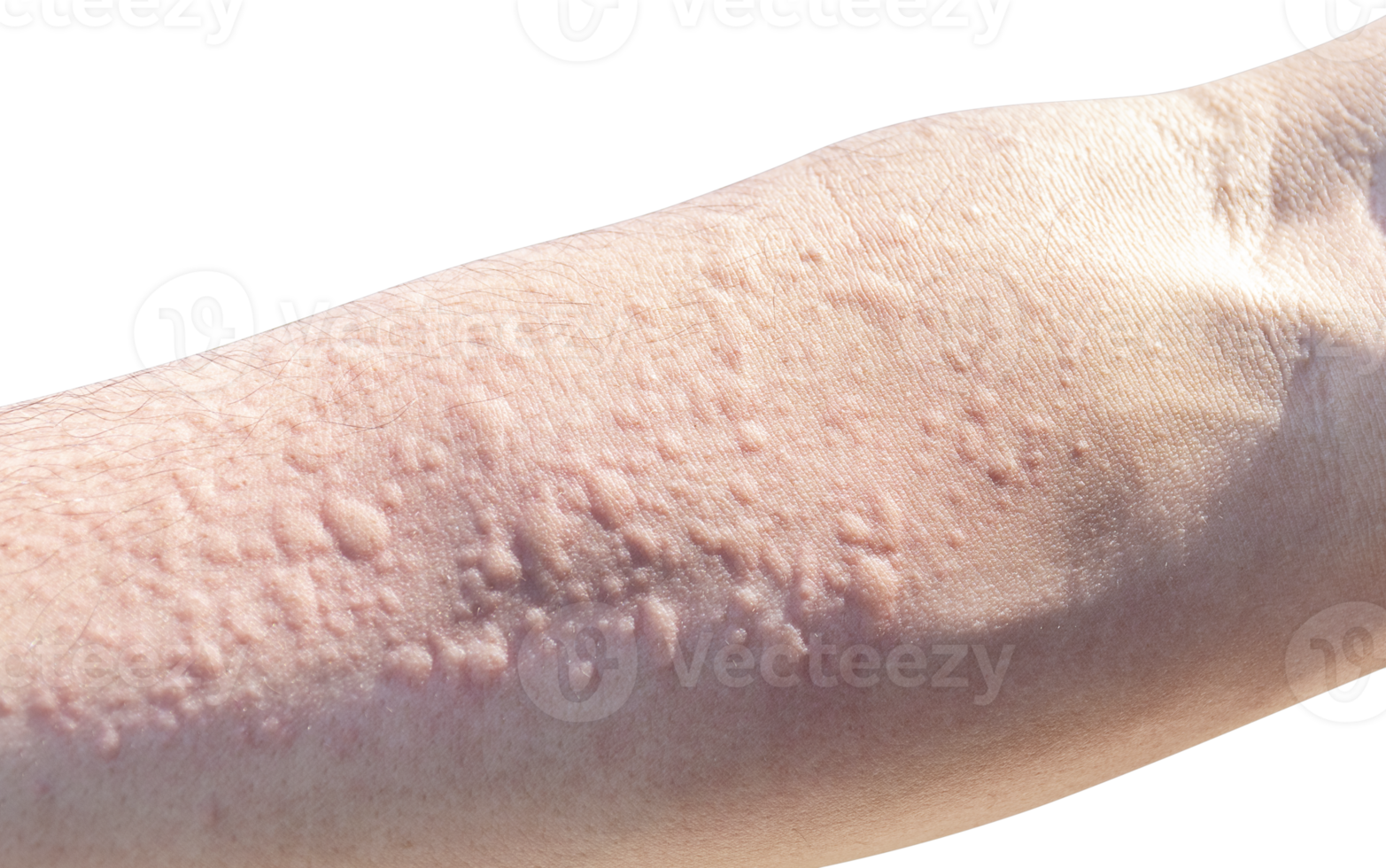 Allergic reaction to dust on arm png