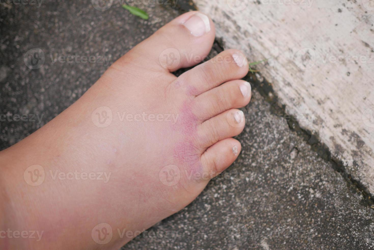 close up of women feet with swelling photo