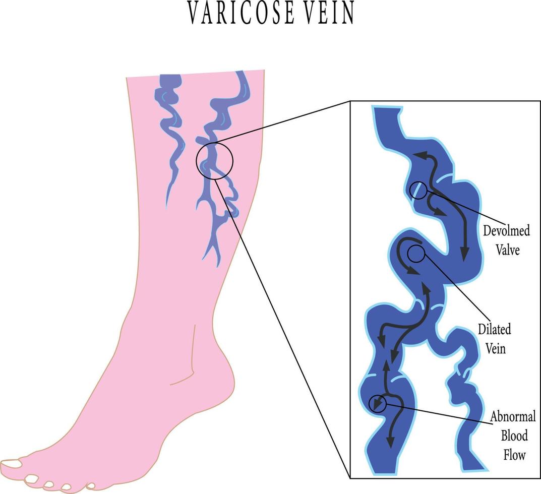 varicoso las venas póster. vector plano estilo dibujos animados varicoso ilustración aislado en blanco antecedentes