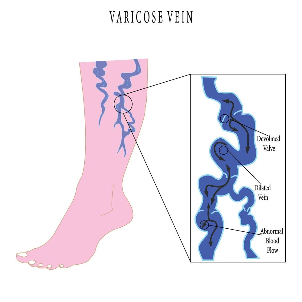 Varicose veins poster. Vector flat style cartoon varicose illustration isolated on white background