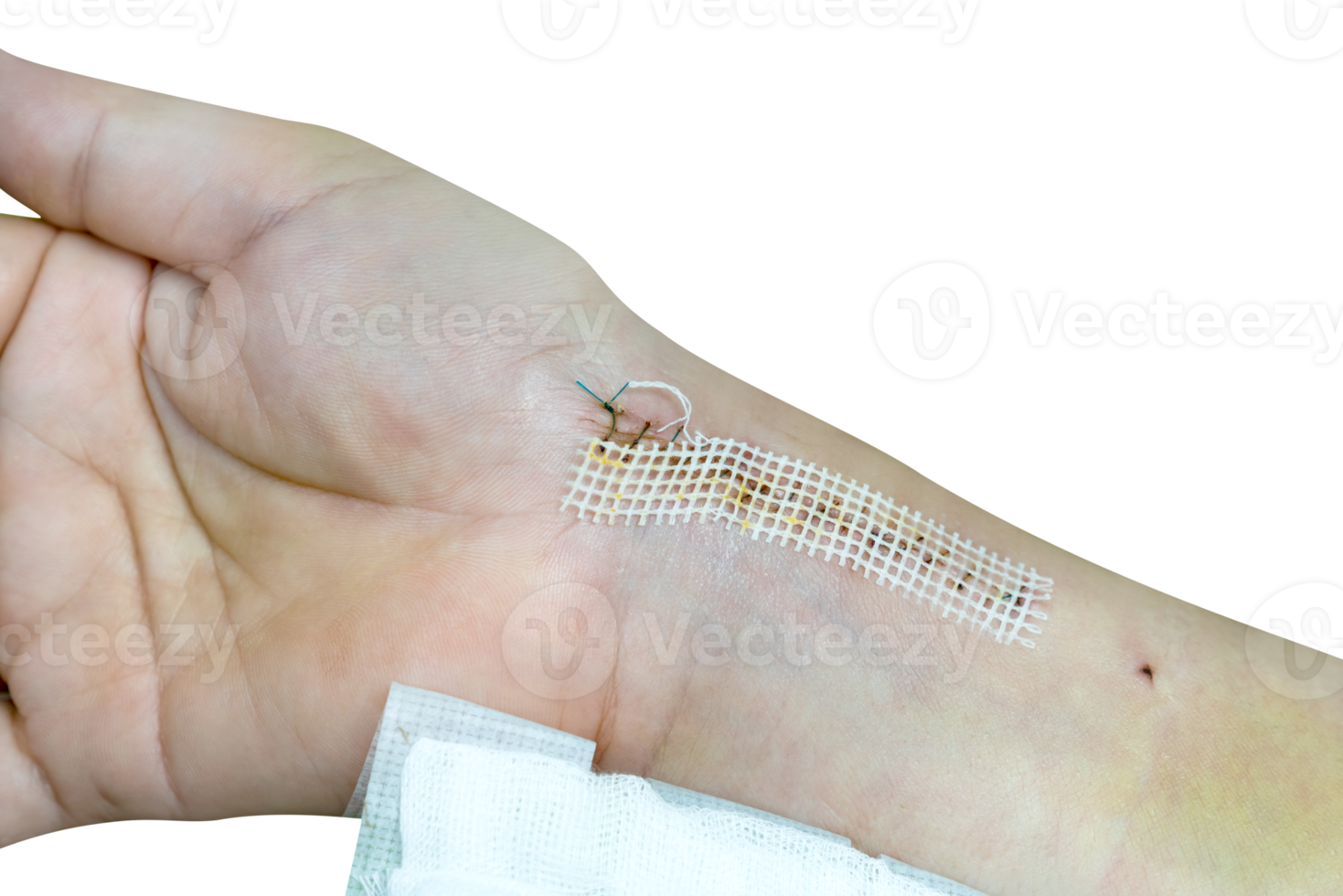 Suture wound on wrist  from accident isolated png