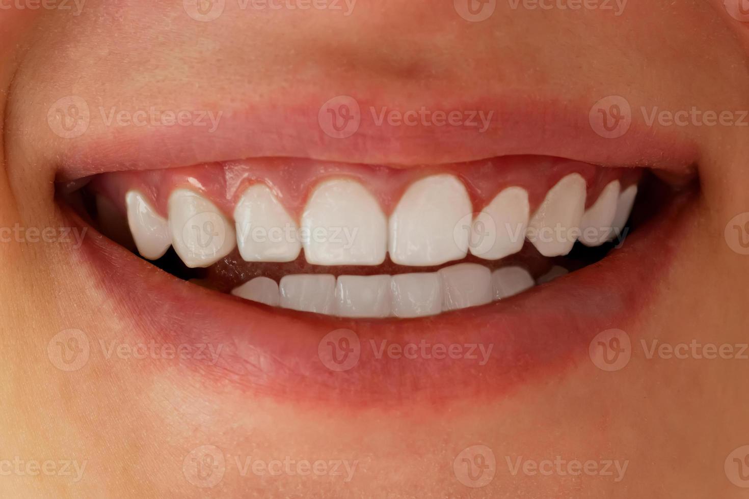 White teeth close-up. Dental whitening. photo