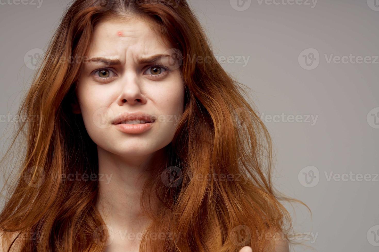 red-haired woman facial skin problems dermatology light background photo