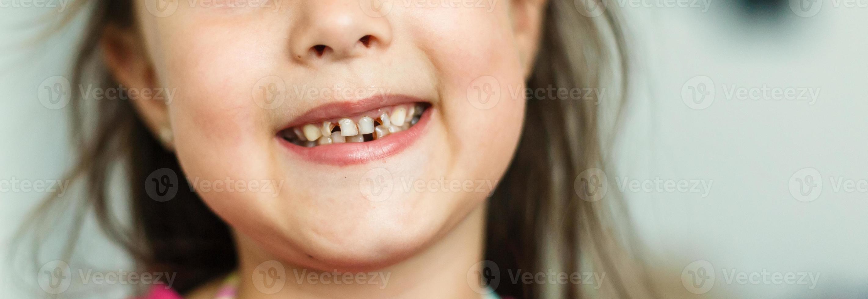 Little girl fell a baby tooth. Child's mouth with hole between the teeth. Shallow dept of field photo