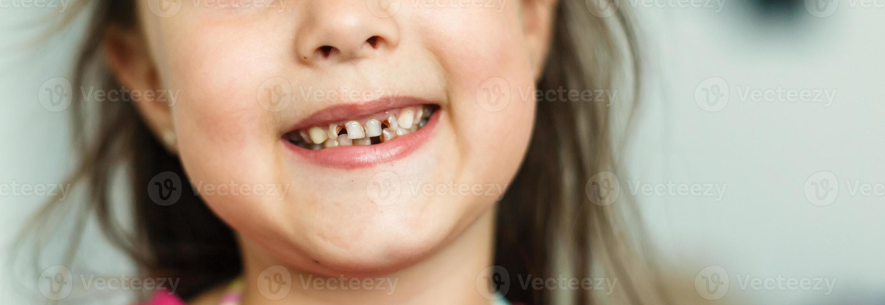 pequeño niña cayó un bebé diente. niño boca con agujero Entre el dientes. superficial departamento de campo foto