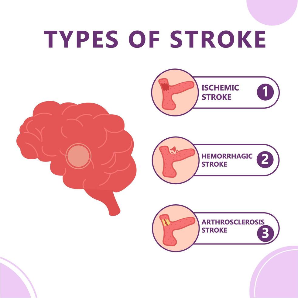Infographic of types of brain stroke vector