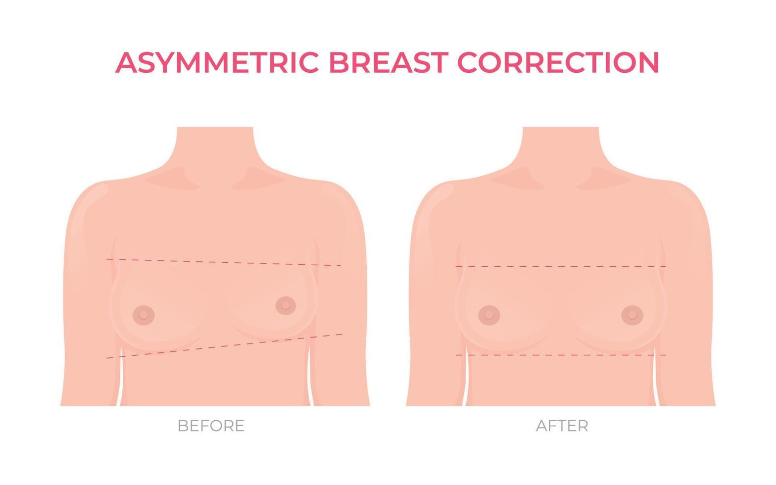 Asymmetric breast correction before and after plastic surgery front view vector