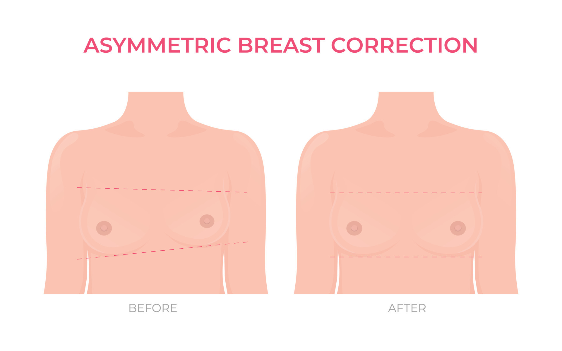 Asymmetric breast correction before and after plastic surgery front view  22603352 Vector Art at Vecteezy