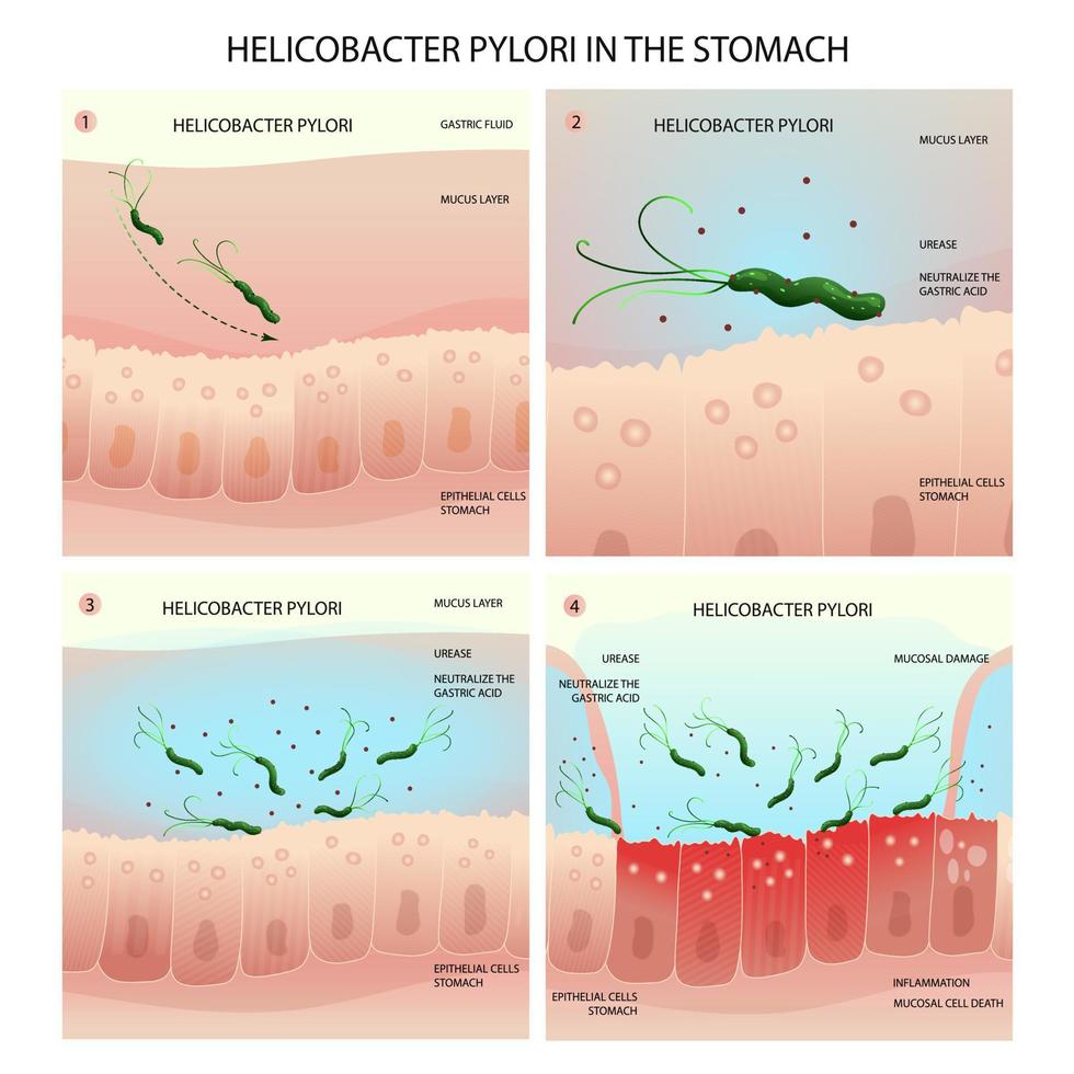 helicobacter pylori infección proceso en humano estómago con gastritis desarrollo vector