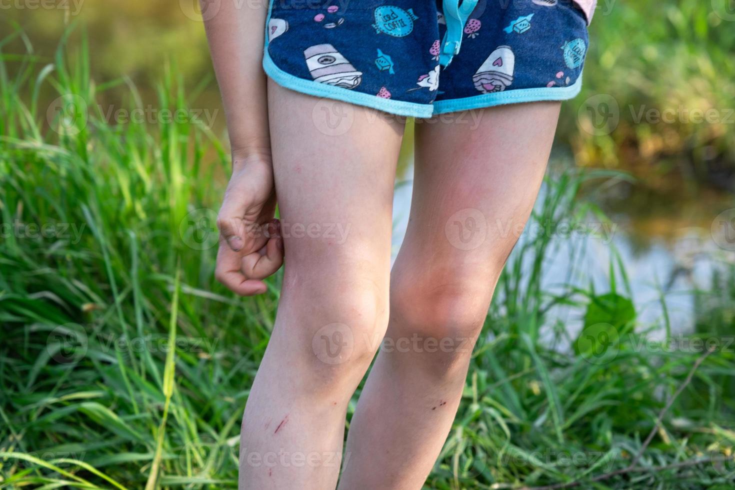 Girl sprays mosquito spray on the skin in nature that bite her hands and feet. Protection from insect bites, repellent safe for children. Outdoor recreation, against allergies. Summer time photo