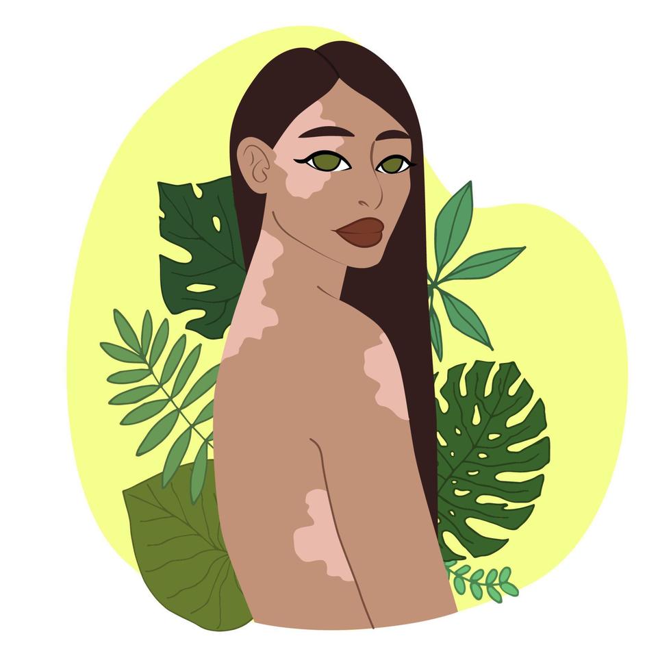 joven mujer con vitíligo. belleza es diversidad. mundo vitiligo día. vector ilustración en plano estilo