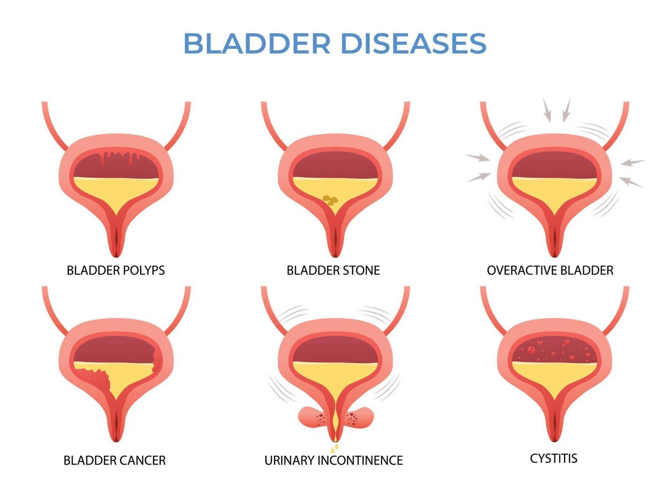 Urology and urinary system. BLADDER DISEASES vector