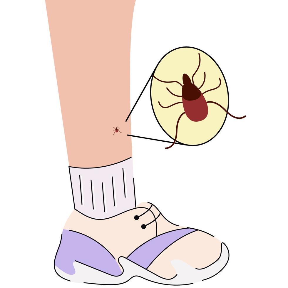 The human leg with  the tick bite. Tick bite leg.Tick bite.  Healthcare illustration. vector