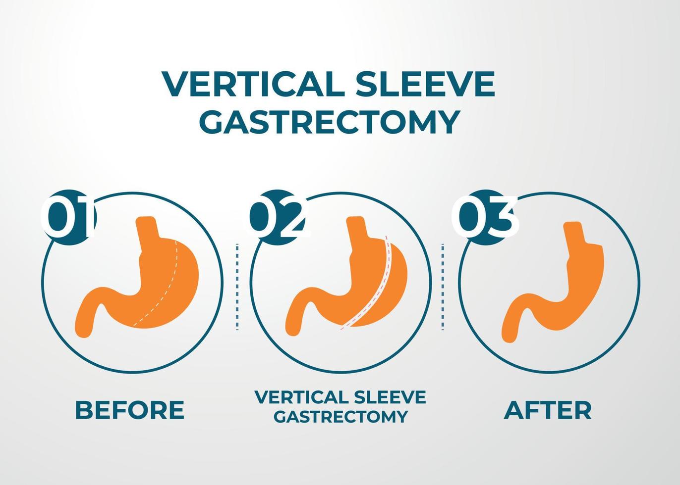 Laparoscopic Sleeve Gastrectomy, Vertical Gastrectomy, Weight loss surgery Vector Illustration of Stomach reduction surgery