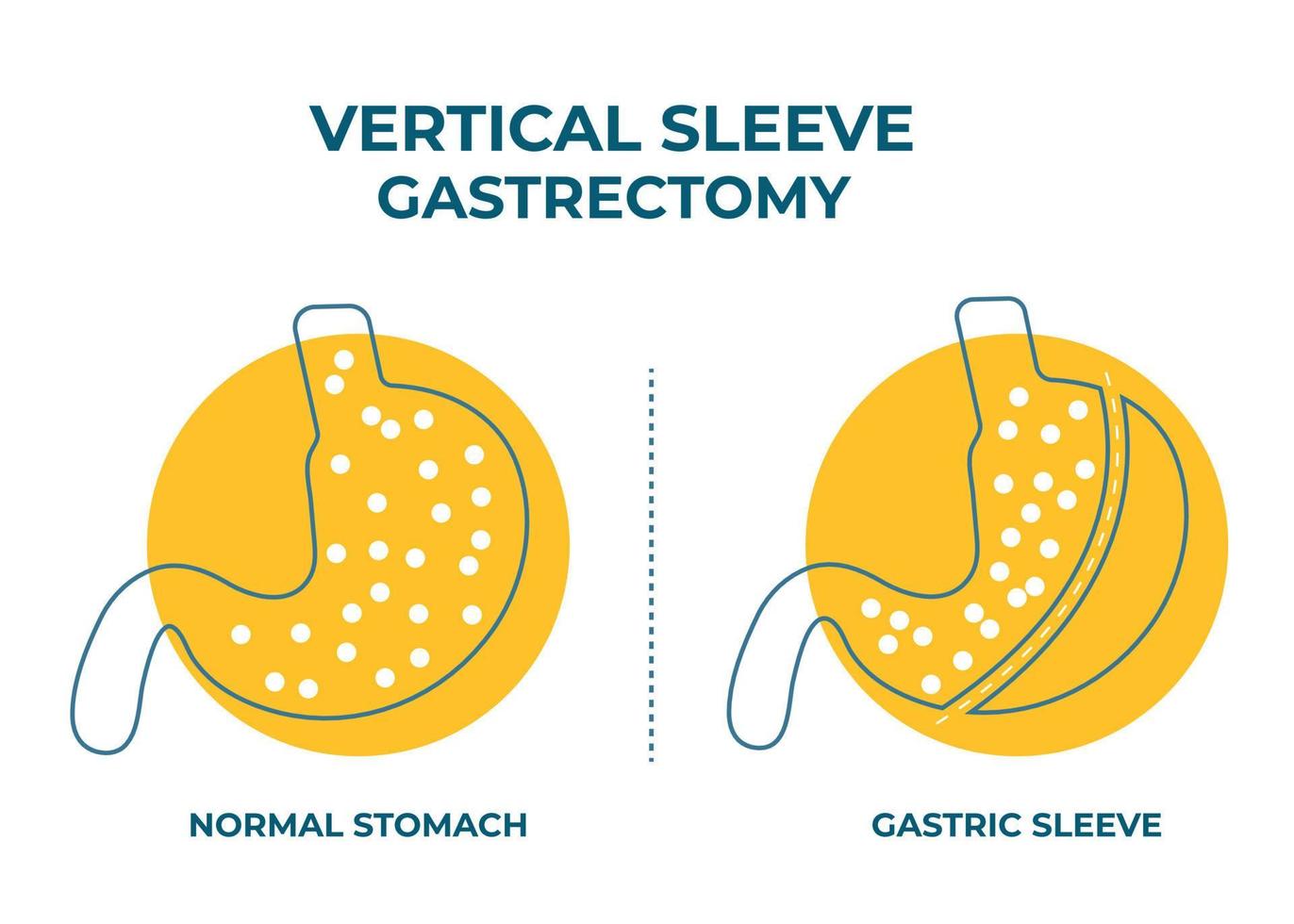 gastrectomía en manga laparoscópica, gastrectomía vertical, cirugía de pérdida de peso ilustración vectorial de cirugía de reducción de estómago vector