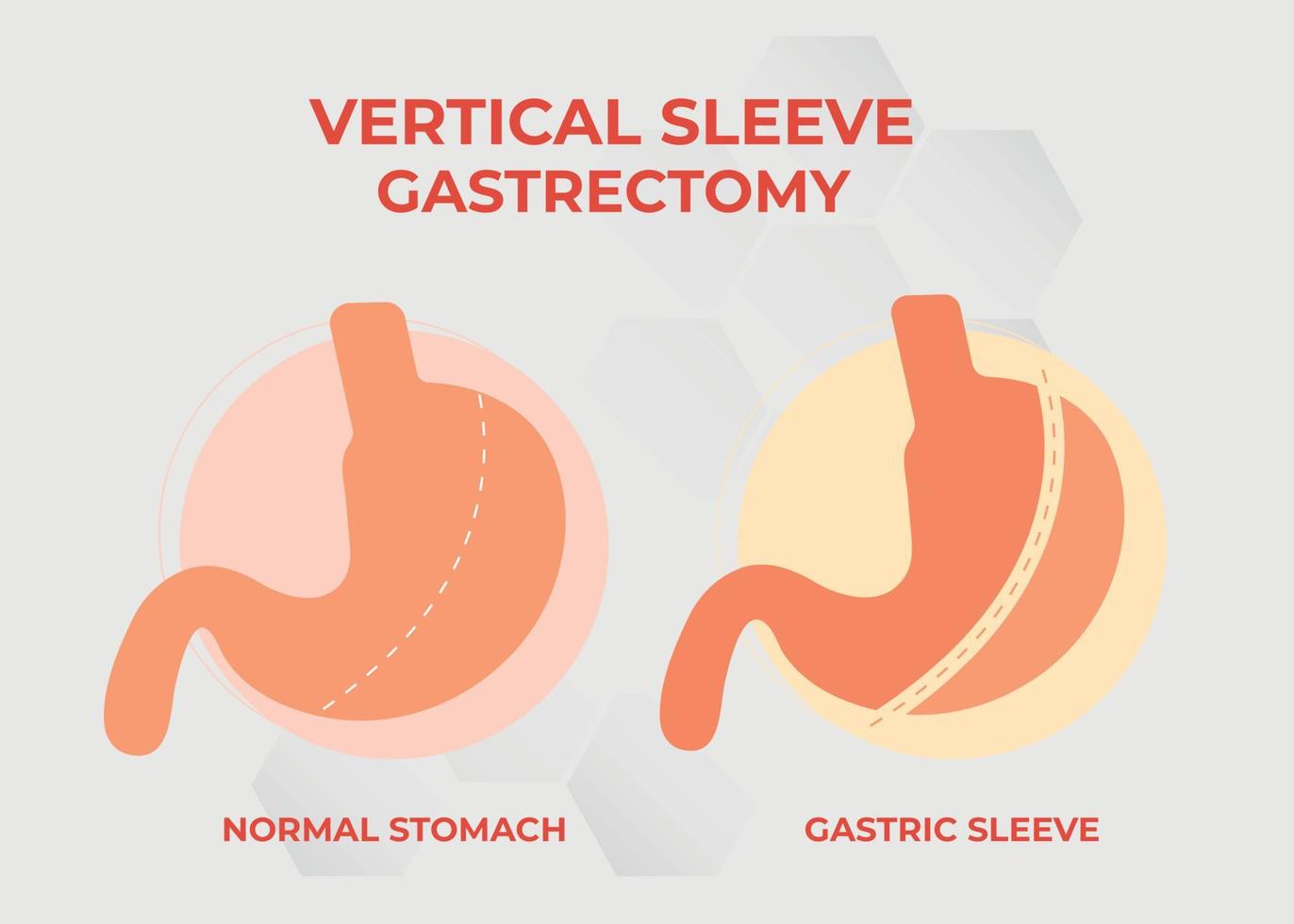 Laparoscopic Sleeve Gastrectomy, Vertical Gastrectomy, Weight loss surgery Vector Illustration of Stomach reduction surgery