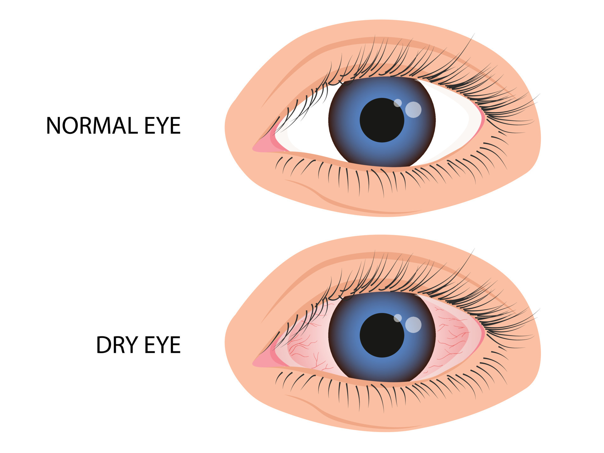 Human eye healthy and dry. Symptoms of keratitis, allergy, conjunctivitis,  uveitis 22720644 Vector Art at Vecteezy